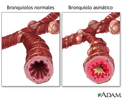 Bronquiolo normal vs. bronquiolo asmtico